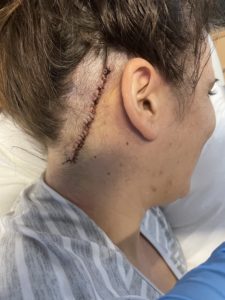 Jessica's surgery scar